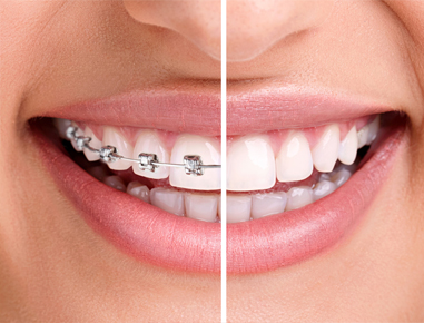 Orthodontic treatment involves prevention & correction of misaligned teeth...