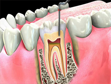 Root canal treatment is save the tooth by removing the pulp tissue of the tooth.